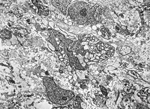 F,12y. | liposarcoma v.s.- orbita